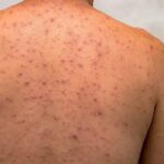 Ceará confirma segundo caso de Mpox em 2026 e mantém oito casos suspeitos sob investigação, aponta Secretaria da Saúde