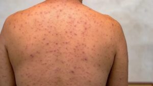 Ceará confirma segundo caso de Mpox em 2026 e mantém oito casos suspeitos sob investigação, aponta Secretaria da Saúde